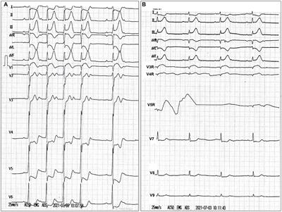 Case report: Acute ST-elevation myocardial infarction and cardiogenic shock caused by a giant right sinus of Valsalva aneurysm and right coronary artery compression